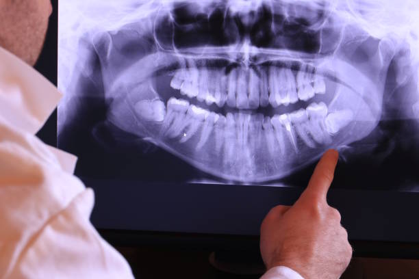 Best Emergency Tooth Extraction in Dexter, MI